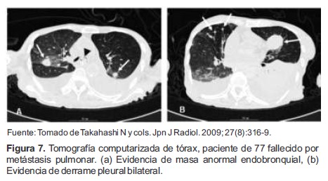 Tomografía computarizada de tórax, paciente de 77 fallecido por metástasis pulmonar. (a) Evidencia de masa anormal endobronquial, (b) Evidencia de derrame pleural bilateral.