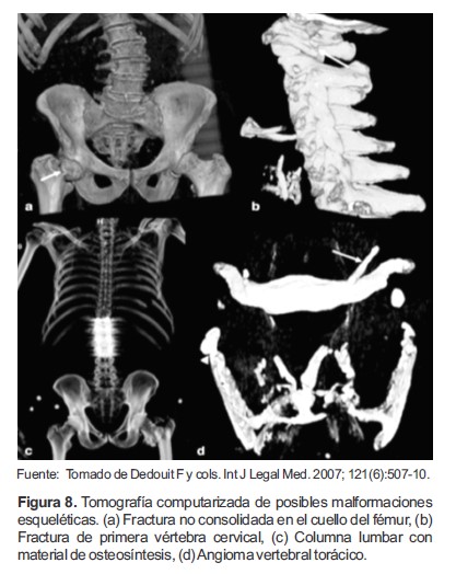 Tomografía computarizada de posibles malformaciones esqueléticas. (a) Fractura no consolidada en el cuello del fémur, (b) Fractura de primera vértebra cervical, (c) Columna lumbar con material de osteosíntesis, (d) Angioma vertebral torácico.