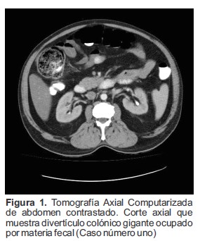 Tomograf&iacute;a Axial Computarizada de abdomen contrastado. Corte axial que muestra divert&iacute;culo col&oacute;nico gigante ocupado por materia fecal (Caso n&uacute;mero uno)