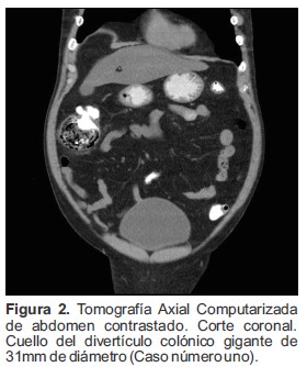 Tomograf&iacute;a Axial Computarizada de abdomen contrastado Corte coronal Cuello del divert&iacute;culo col&oacute;nico gigante de 31mm de di&aacute;metro Caso n&uacute;mero uno