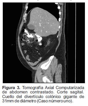 Tomograf&iacute;a Axial Computarizada de abdomen contrastado. Corte sagital. Cuello del divert&iacute;culo col&oacute;nico gigante de 31mm de di&aacute;metro (Caso n&uacute;mero uno).