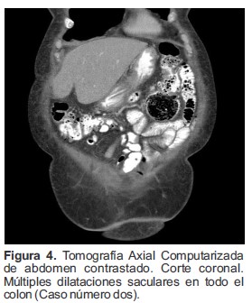Tomograf&iacute;a Axial Computarizada de abdomen contrastado Corte coronal M&uacute;ltiples dilataciones saculares en todo el colon Caso n&uacute;mero dos
