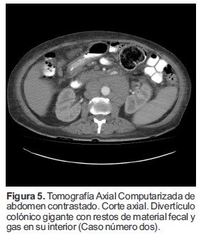 Tomograf&iacute;a Axial Computarizada de abdomen contrastado. Corte axial. Divert&iacute;culo col&oacute;nico gigante con restos de material fecal y gas en su interior (Caso n&uacute;mero dos).