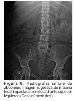 Radiograf&iacute;a simple de abdomen Imagen sugestiva de materia fecal impactada en el cuadrante superior izquierdo Caso n&uacute;mero dos