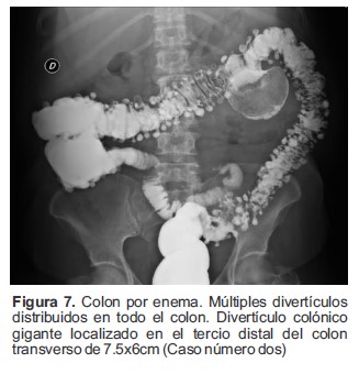 Colon por enema M&uacute;ltiples divert&iacute;culos distribuidos en todo el colon Divert&iacute;culo col&oacute;nico gigante localizado en el tercio distal del colon transverso de 75x6cm Caso n&uacute;mero dos
