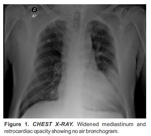 CHEST XRAY Widened mediastinum and retrocardiac opacity showing no air bronchogram