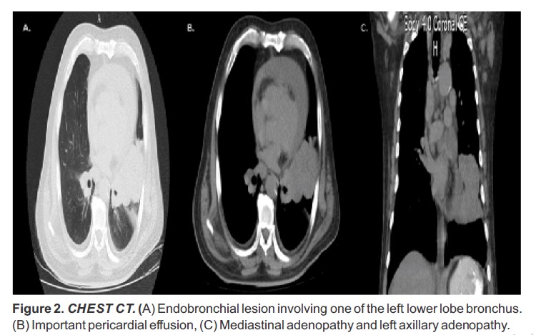 CHEST CT. (A) Endobronchial lesion involving one of the left lower lobe bronchus. (B) Important pericardial effusion, (C) Mediastinal adenopathy and left axillary adenopathy.