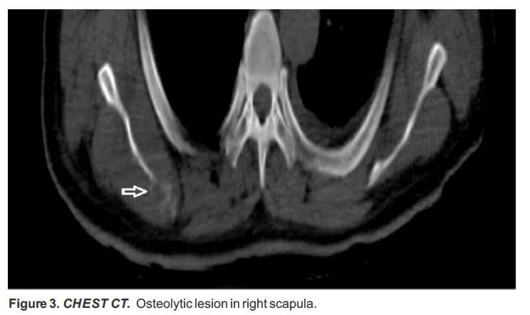 CHEST CT Osteolytic lesion in right scapula