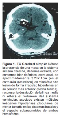 TC Cerebral simple N&oacute;tese la presencia de una masa en la cisterna silviana derecha de forma ovalada con contornos bien definidos extra axial de aproximadamente 32x21cm en el corte axial asterisco en relaci&oacute;n a otra lesi&oacute;n de forma irregular hiperdensa en su porci&oacute;n m&aacute;s anterior flecha blanca no presenta desviaci&oacute;n de la l&iacute;nea media ni altera el volumen del sistema ventricular asociado existen m&uacute;ltiples im&aacute;genes hipodensas globulares de menor tama&ntilde;o en las cisternas basales y el espacio subaracnoideo de ambos hemisferios