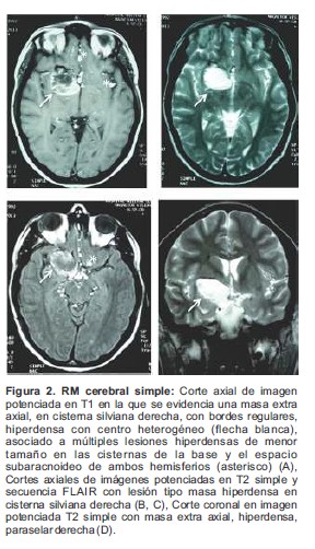 RM cerebral simple: Corte axial de imagen potenciada en T1 en la que se evidencia una masa extra axial, en cisterna silviana derecha, con bordes regulares, hiperdensa con centro heterog&eacute;neo (flecha blanca), asociado a m&uacute;ltiples lesiones hiperdensas de menor tama&ntilde;o en las cisternas de la base y el espacio subaracnoideo de ambos hemisferios (asterisco) (A), Cortes axiales de im&aacute;genes potenciadas en T2 simple y secuencia FLAIR con lesi&oacute;n tipo masa hiperdensa en cisterna silviana derecha (B, C), Corte coronal en imagen potenciada T2 simple con masa extra axial, hiperdensa, paraselar derecha (D).