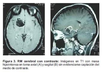 RM cerebral con contraste: Im&aacute;genes en T1 con masa hipointensa en toma axial (A) y sagital (B) sin evidenciarse captaci&oacute;n del medio de contraste.
