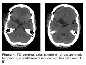 TC cerebral axial simple en el posoperatorio temprano que confirma la resecci&oacute;n completa del tumor A B