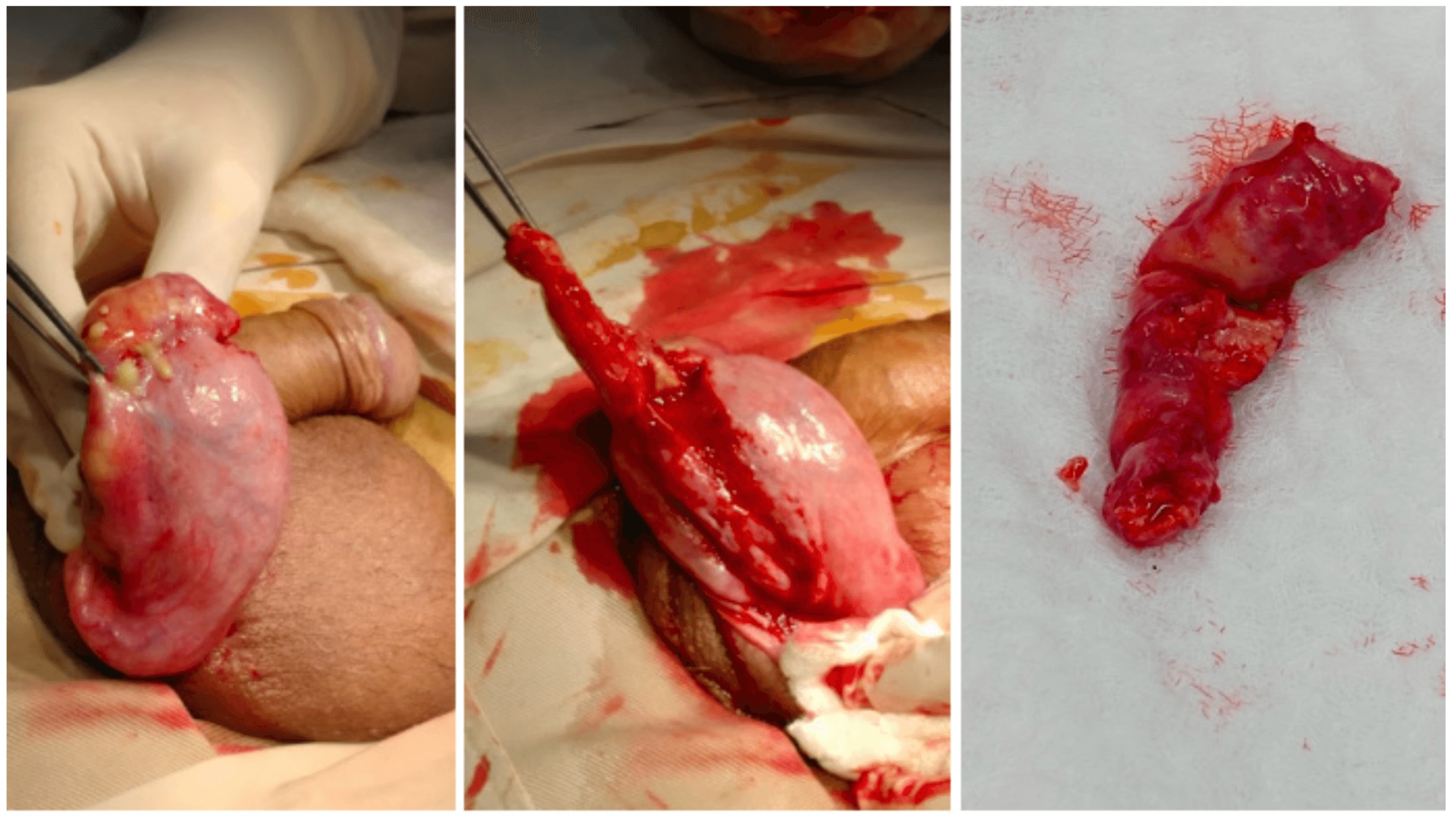 Figura 1. Hallazgos intraoperatorios de hidrocelectomía y epididimectomía derecha. Epidídimo derecho engrosado y caliente al tacto, que se punciona y drena material caseoso y purulento. Testículo derecho indurado sin áreas evidentes de secreción. 