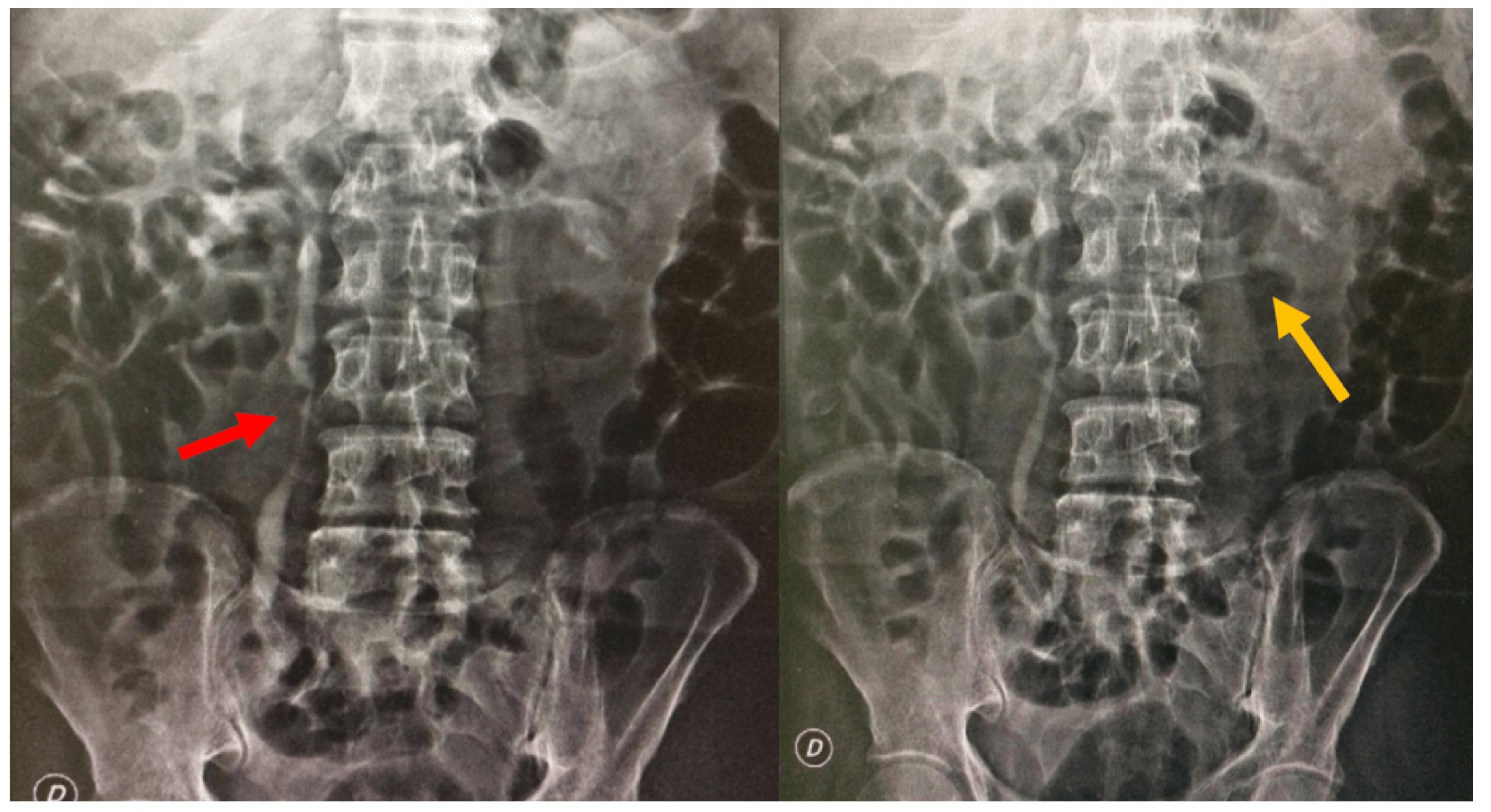Figura 2. Urografía excretora. Dilatación ureteral bilateral de predominio derecho (flecha roja). Se sugiere retardo en la eliminación del medio de contraste bilateral (flecha amarilla).