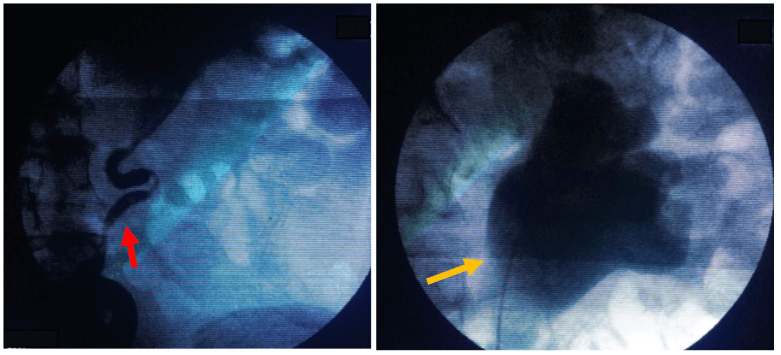Figura 3. Pielografía retrógrada izquierda. Se confirman los hallazgos de la urografía intravenosa. Dilatación ureteral con múltiples zonas de estrechez (flecha roja). Dilatación pielocalicial (flecha amarilla).