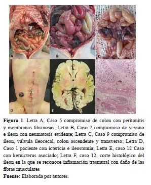 Letra A Caso 5 compromiso de colon con peritonitis y membranas fibrinosas Letra B Caso 7 compromiso de yeyuno e íleon con neumatosis evidente Letra C Caso 9 compromiso de íleon válvula ileocecal colon ascendente y transverso Letra D Caso 1 paciente con ictericia e ileostomía Letra E caso 12 Caso con kernicterus asociado Letra F caso 12 corte histológico del íleon en la que se reconoce inflamación trasmural con daño de las fibras musculares