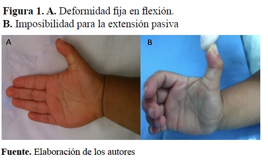  A. Deformidad fija en flexión. B. Imposibilidad para la extensión pasiva