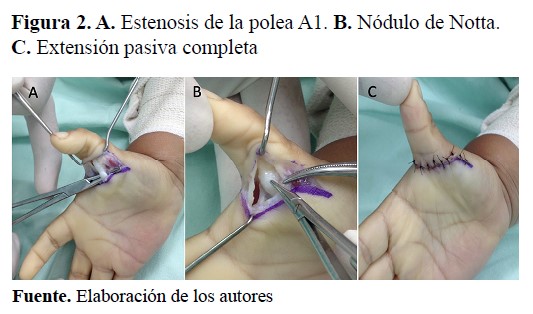 A. Estenosis de la polea A1. B. Nódulo de Notta. C. Extensión pasiva completa