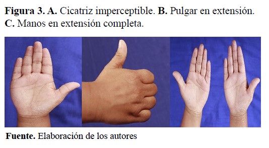 A. Cicatriz imperceptible. B. Pulgar en extensión. C. Manos en extensión completa