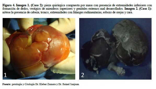 Imagen 1 Caso 2 pieza quirúrgica compuesta por masa con presencia de extremidades inferiores con formación de dedos vestigios de miembros superiores y genitales externos mal desarrollados Imagen 2 Caso 1 nótese la presencia de cabeza tronco extremidades con falanges rudimentarias esbozo de orejas y cara