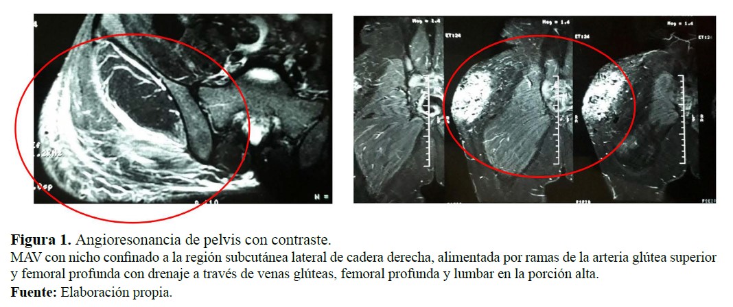 Angioresonancia de pelvis con contraste