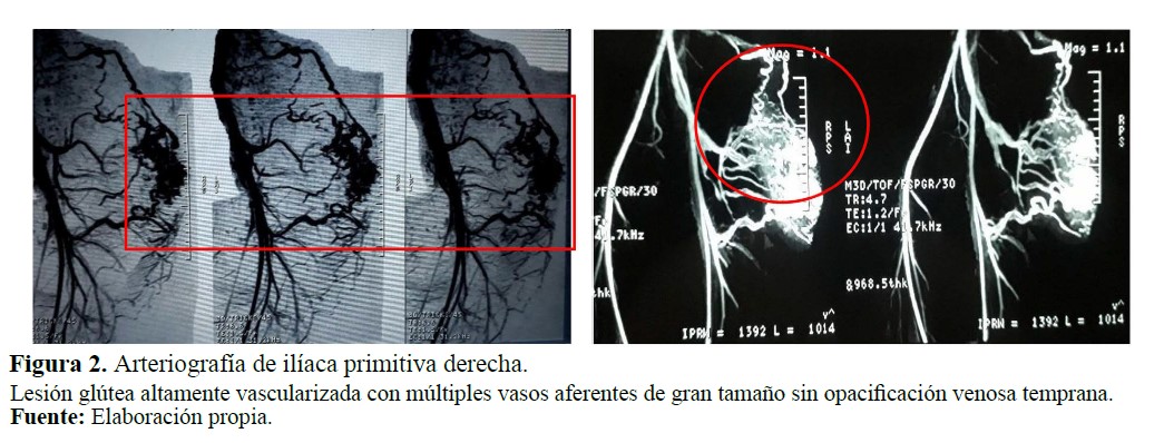 Arteriografía de ilíaca primitiva derecha.