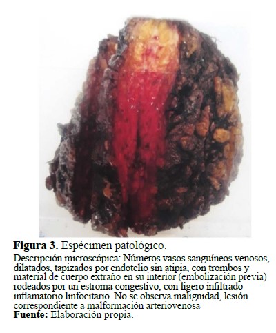 Espécimen patológico