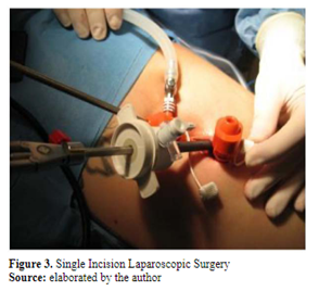 Figure 3. Single Incision Laparoscopic Surgery