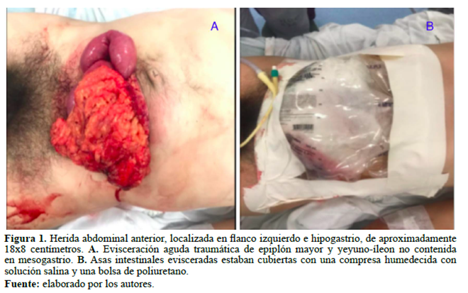 Figura 1. Herida abdominal anterior, localizada en flanco izquierdo e hipogastrio, de aproximadamente 18x8 centímetros. A. Evisceración aguda traumática de epiplón mayor y yeyuno-íleon no contenida en mesogastrio. B. Asas intestinales evisceradas estaban cubiertas con una compresa humedecida con solución salina y una bolsa de poliuretano