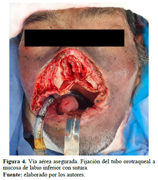 Figura 4. Vía aérea asegurada. Fijación del tubo orotraqueal a mucosa de labio inferior con sutura