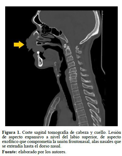Figura 1. Corte sagital tomografía de cabeza y cuello. Lesión de aspecto expansivo a nivel del labio superior, de aspecto exofítico que comprometía la unión frontonasal, alas nasales que se extendía hasta el dorso nasal.