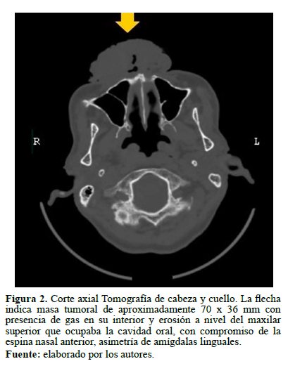 Figura 2. Corte axial Tomografía de cabeza y cuello. La flecha indica masa tumoral de aproximadamente 70 x 36 mm con presencia de gas en su interior y erosión a nivel del maxilar superior que ocupaba la cavidad oral, con compromiso de la espina nasal anterior, asimetría de amígdalas linguales