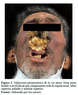 Figura 3. Valoración preanestésica de la vía aérea. Gran masa friable a nivel facial que comprometía toda la región nasal, labio superior, paladar y maxilar superior.