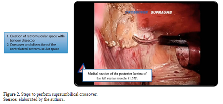 Figure 2. Steps to perform supraumbilical crossover.