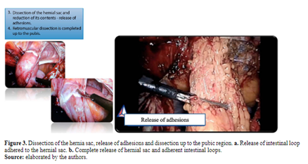 Figure 3. Dissection of the hernia sac, release of adhesions and dissection up to the pubic region. a. Release of intestinal loop adhered to the hernial sac. b. Complete release of hernial sac and adherent intestinal loops.
