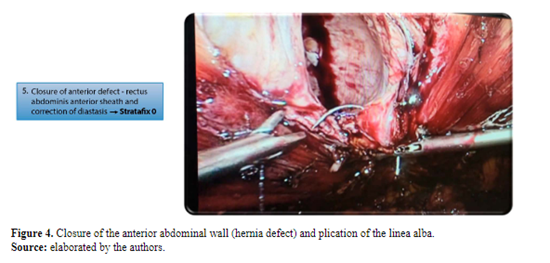 Figure 4. Closure of the anterior abdominal wall (hernia defect) and plication of the linea alba.