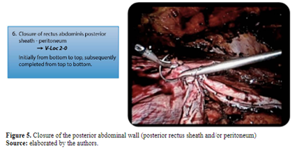 Figure 5. Closure of the posterior abdominal wall (posterior rectus sheath and/or peritoneum)
