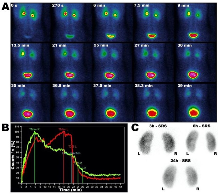 Results of a dynamic renal scintigraphy (DRS) using [99mTc]TcDTPA2-, with total elimination of the tracer from the renal cortex into the  urinary bladder along time (A), together with associated normal renogram  to determine if the kidney is dilated and/or obstructed (red line: left kidney;  green line: right kidney; quantification was performed on posterior view) (B) and static renal scintigraphy (SRS) images demonstrating the absence of remnant  material in the kidneys in the 24 h image (C).