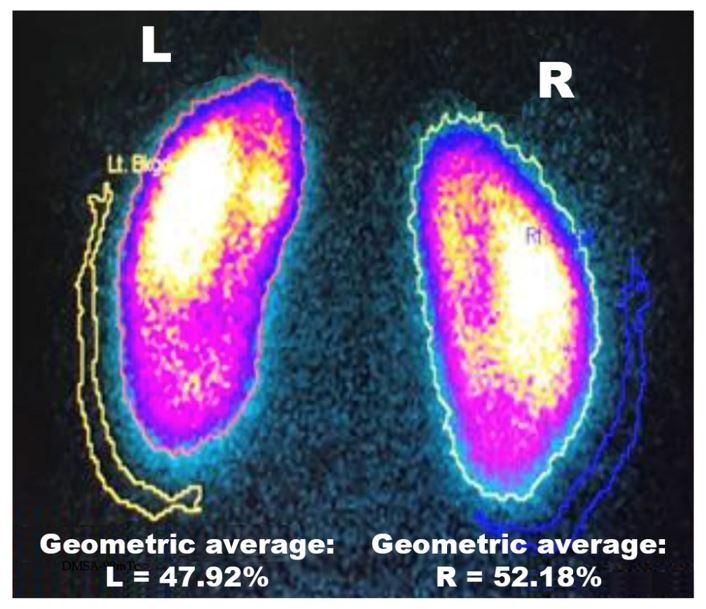 Results of a [99mTc]TcDMSA2- image demonstrating the automatic contour of each kidney and  corresponding backgrounds, considered without alterations (i.e. normal).