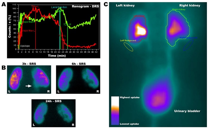Renogram (DRS) of patient 23 (P23) evidencing the dilation and delay of  elimination in the right kidney (green line), demonstrating retention of the  radiotracer until the 20th min, with a decrease followed by increase  of tracer retention after furosemide administration, resulting in an  undetermined pattern (A); SRS images demonstrating the presence of  remnant radiotracer in the right ureter in the 3 h image (B, inserted  arrow) allowing to observe a retention of the tracer at renal  pelvis on 3 h imaging, a pattern that is not demonstrated in the 6 h and 24 h  images; and composed image integrating  all images acquired during the 40 min exam, with a colorimetric scale (C).