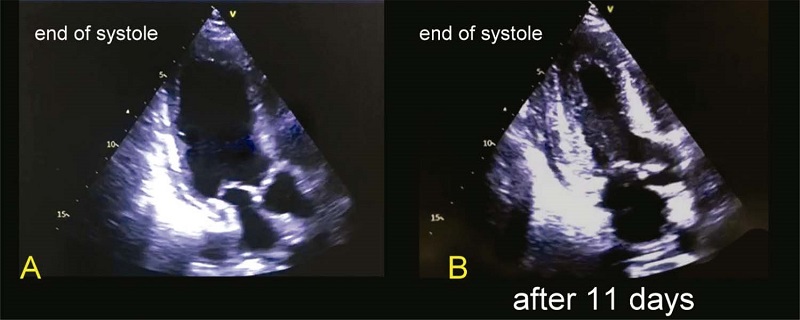 &ndash; Three cases of Takotsubo cardiomyopathy with complete recovery.