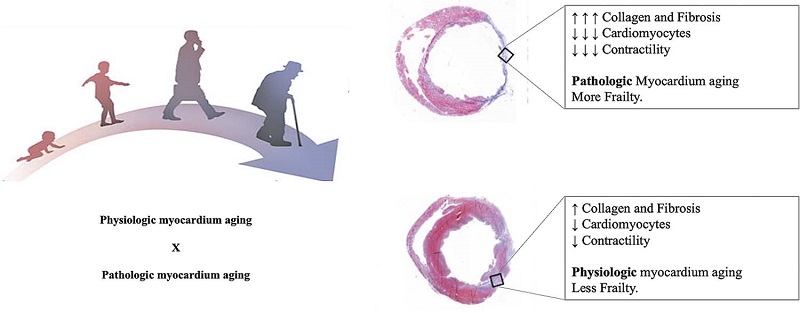 &ndash; Cardiovascular aging process. Aging is not a homogenous process. Myocyte loss occurs through apoptotic and/or necrotic pathways, and this results in hypertrophy of remaining myocytes and replacement fibrosis. The changes with age occur in everyone, but not necessarily at the same rate, therefore accounting for the difference seen in some people between chronologic age and physiologic age.