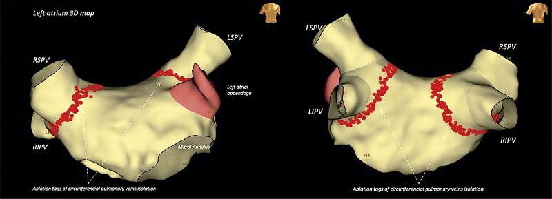 &ndash; Left atrium 3D electroanatomic map. Left atrium 3D electroanatomic map of an 81-year-old male patient, with persistent AF for 3 years and reduced left ventricle ejection fraction (LVEF = 40%). Left: anterior view. Right: posterior view. LIPV: left inferior pulmonary vein; LSPV: left superior pulmonary vein; RIPV: right inferior pulmonary vein; RSPV: right superior pulmonary vein. Red dots: tags of radiofrequency ablation.