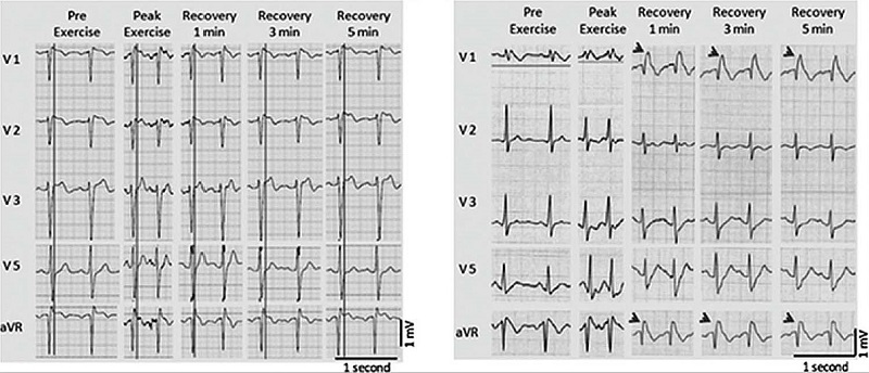– Electrocardiographic changes during exercise stress test in patients with Brugada syndrome (BS). Left panel: ST-segment elevation in precordial leads and lead aVR during early recovery in a patient with type 1 BS. Vertical lines indicate the end of QRS from the V5 lead, representing the peak St elevation. Right panel: example of J-point elevation (arrows) in precordial leads and aVR during early and late recovery; adapted from Subramanian et al. 
							13