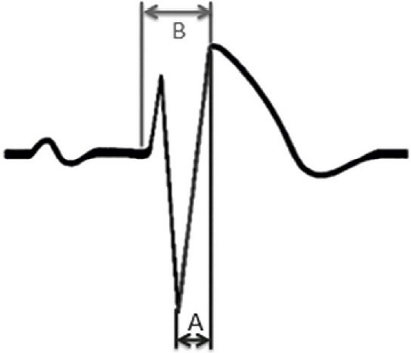 – S-wave slope: ratio between duration of the S-wave upslope and the QRS duration (A/B); A: duration (milliseconds) from S-wave nadir to the J-point. B: duration (milliseconds) from the QRS deflection to the J-point (RJ interval). Adapted from Subramanian et al. 
							13