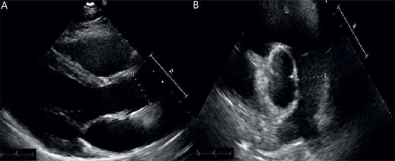 Measurement of ascending Ao (panel A) and PA (panel B) diameters by TTE.