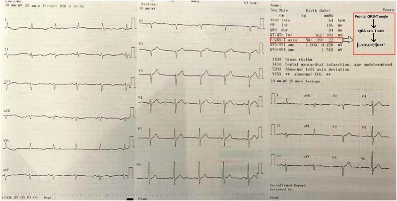 Calculation of frontal QRS-T angle from ECG report.