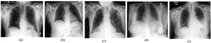 X-rays for each of the selected pathologies. (a) Atelectasis, (b) Cardiomegaly, (c) Consolidation, (d) Edema, (e) Pleural Effusion.