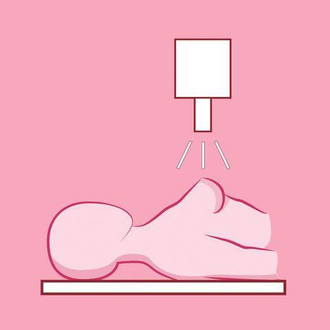 Radioterapia en c&aacute;ncer de mama. 
							[2]