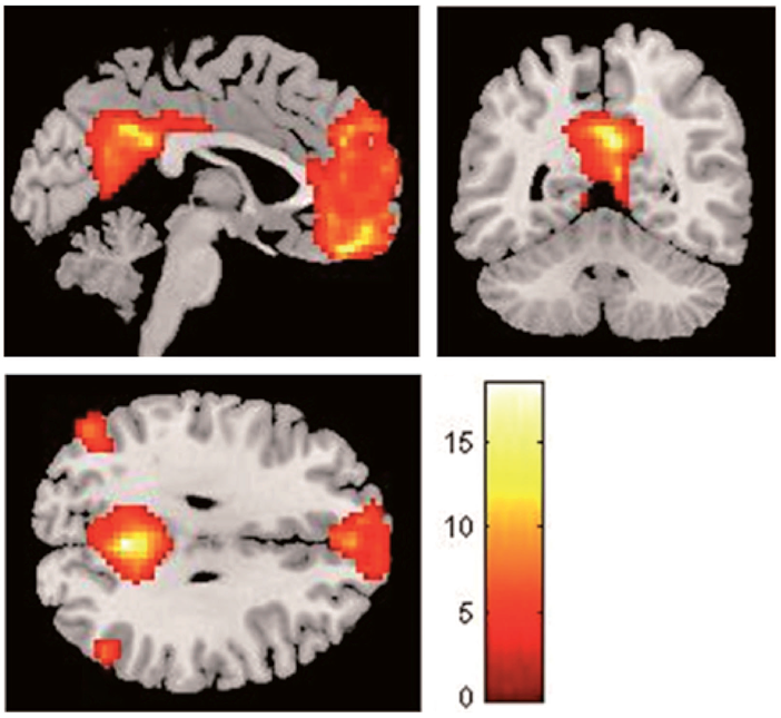 The DMN identified in the resting state condition at the group
level (p < .05, FWE corrected)